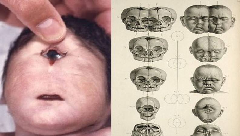 فیلم ترسناک از به دنیا آمدن نوزاد تک چشم در اندونزی