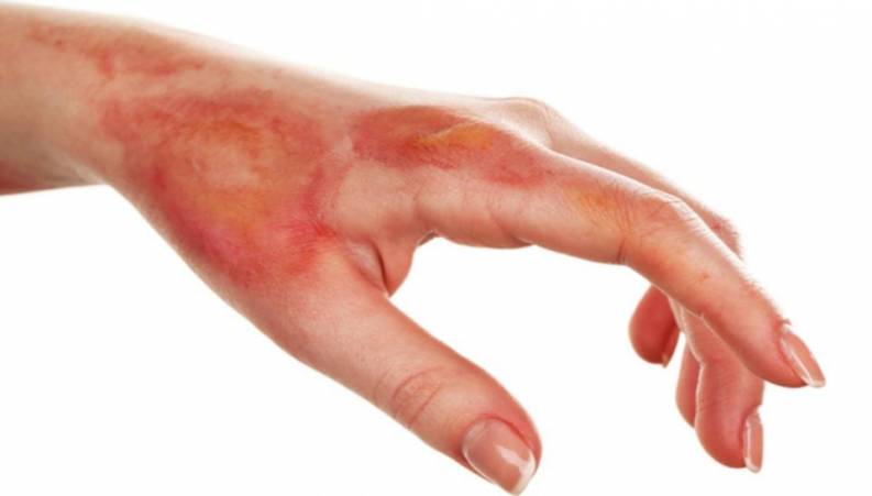 هنگام سوختگی چه اقداماتی باید انجام دهید