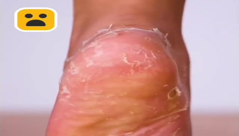 رفع ترک پا به سادگی !