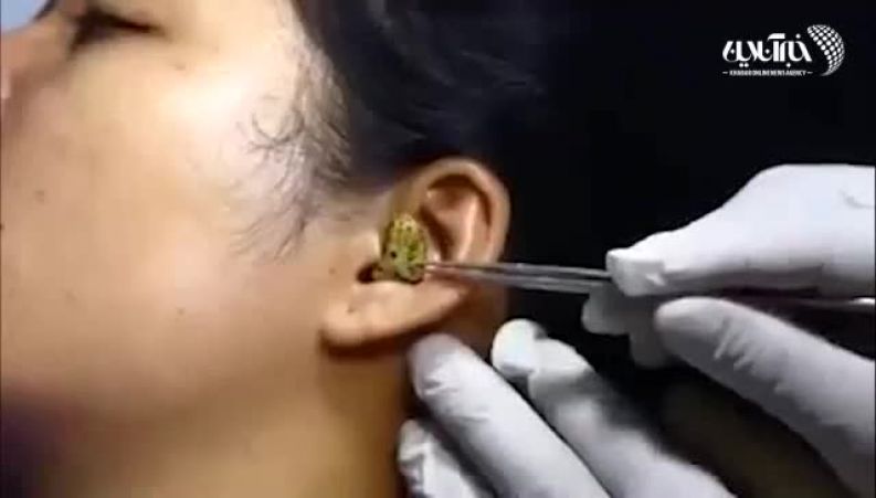 لحظه وحشتناک خارج کردن یک مار از گوش یک دختر جوان + ویدیو