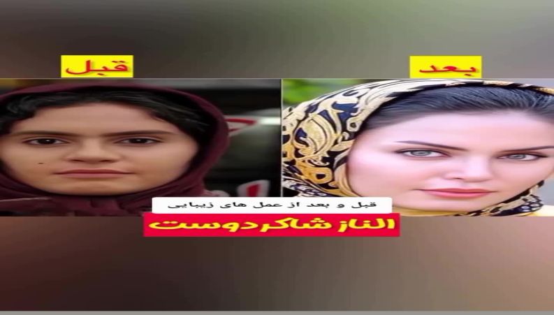 از بینی‌های طبیعی تا چهره‌های ژل‌دار؛ سلبریتی‌ها قبل و بعد از عمل‌های زیبایی