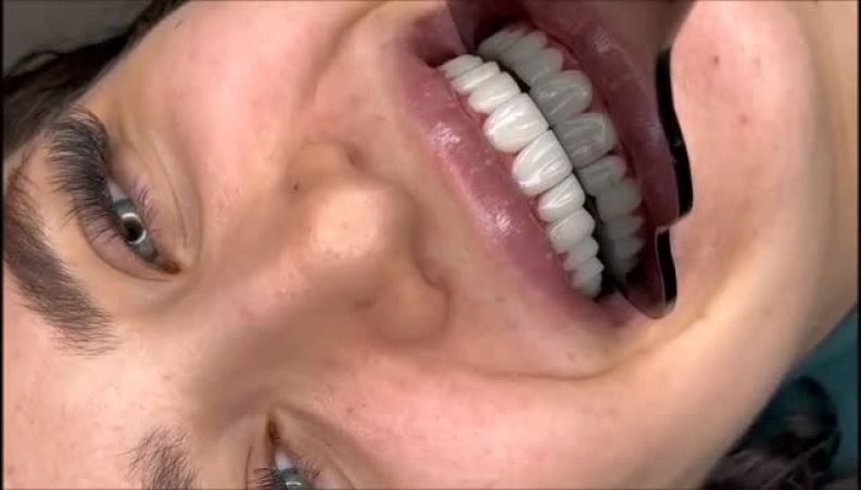 مشاهده نمونه کارهای دندانپزشکی زیبایی در مرکز خدمات تخصصی دندانپزشکی  دنتال وست تهران